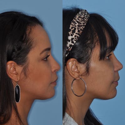 Rhinoplasty Before & After Gallery - Patient 31710063 - Image 2