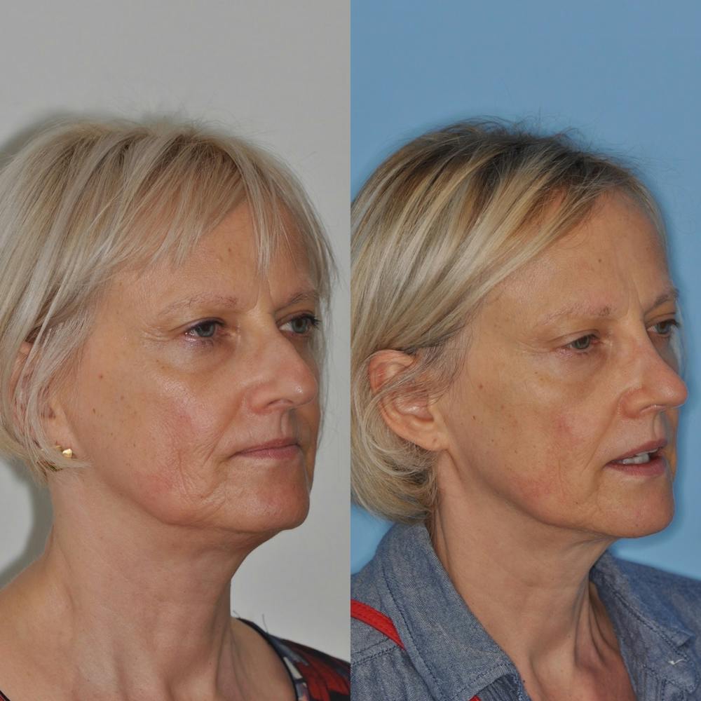 Rhinoplasty Before & After Gallery - Patient 31710066 - Image 1