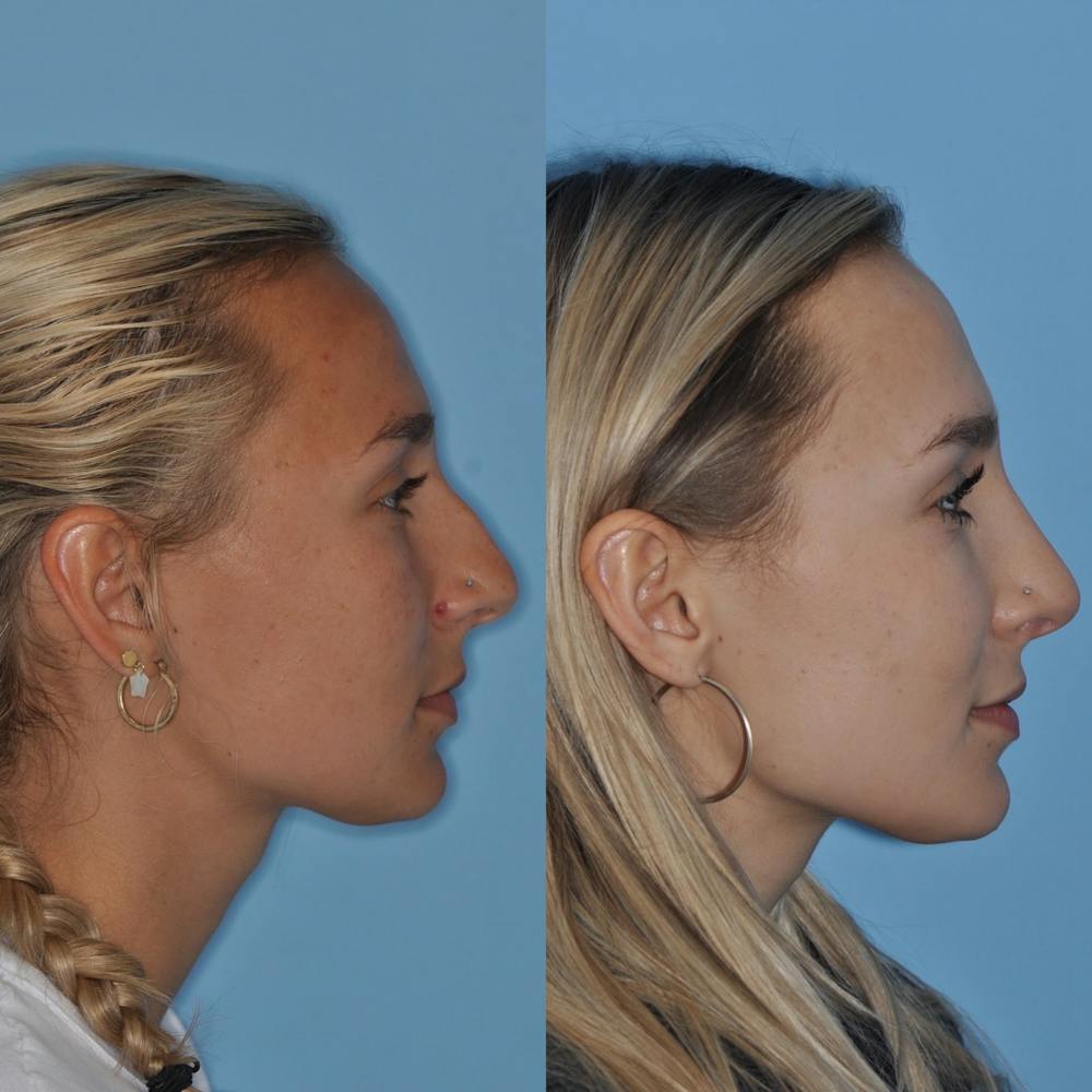 Rhinoplasty Before & After Gallery - Patient 31710065 - Image 2