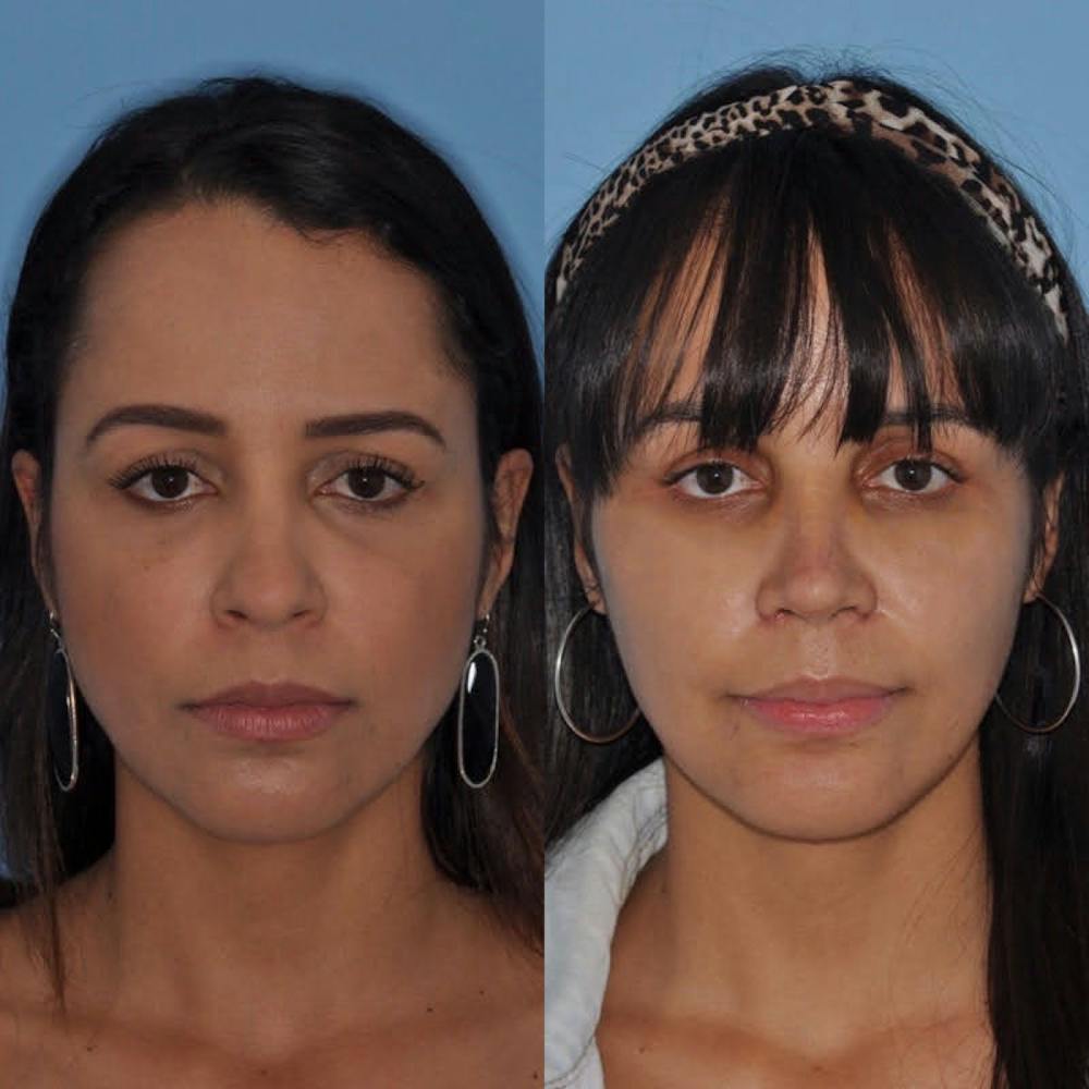 Rhinoplasty Before & After Gallery - Patient 31710063 - Image 3