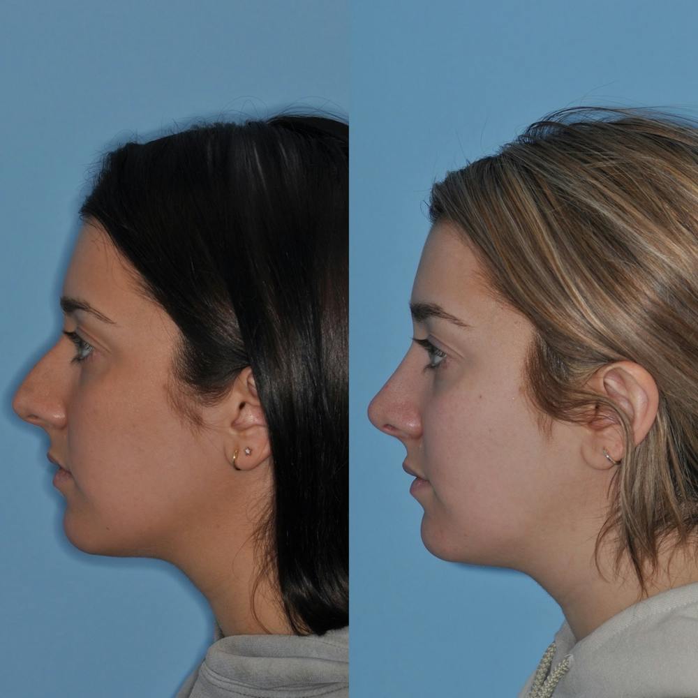 Rhinoplasty Before & After Gallery - Patient 31710064 - Image 3