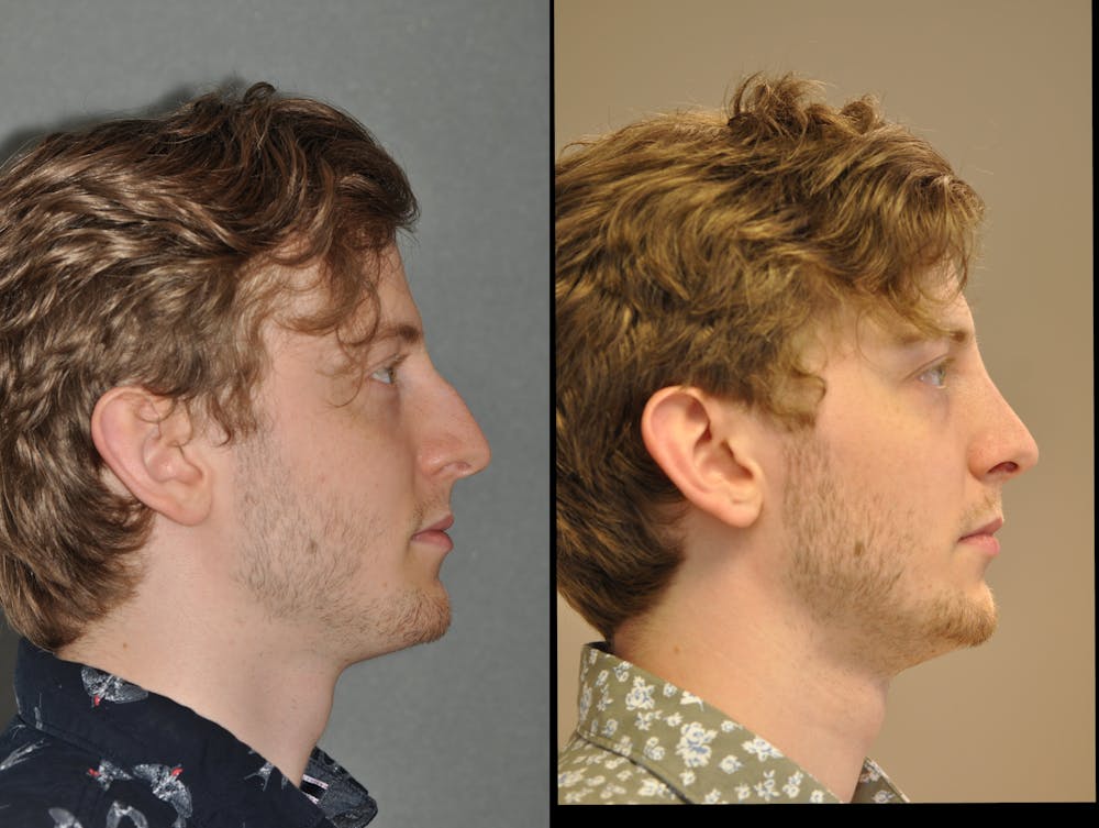 Rhinoplasty Before & After Gallery - Patient 31710067 - Image 1