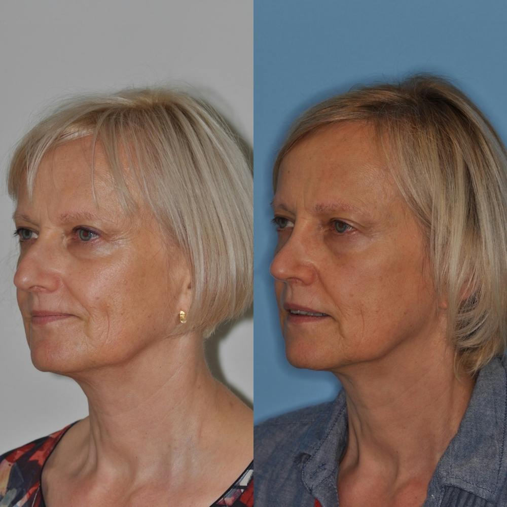Rhinoplasty Before & After Gallery - Patient 31710066 - Image 2