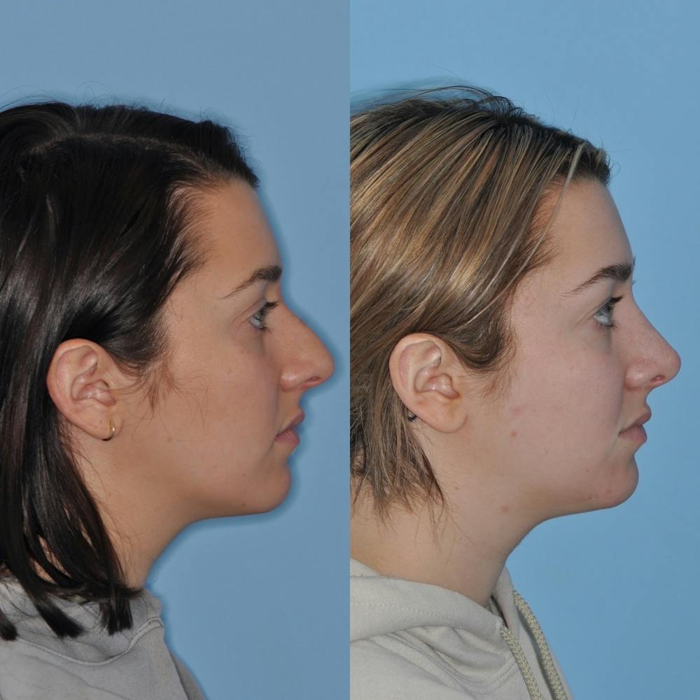 Rhinoplasty Before & After Gallery - Patient 31710064 - Image 4