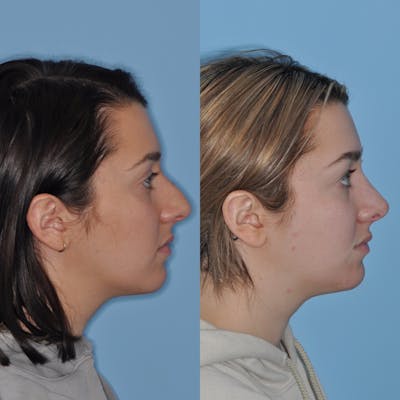 Rhinoplasty Before & After Gallery - Patient 31710064 - Image 4