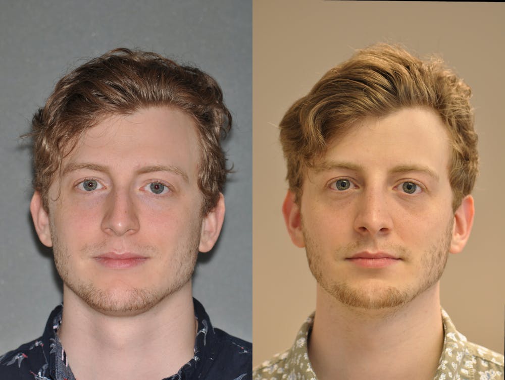 Rhinoplasty Before & After Gallery - Patient 31710067 - Image 2