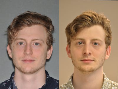 Rhinoplasty Before & After Gallery - Patient 31710067 - Image 2