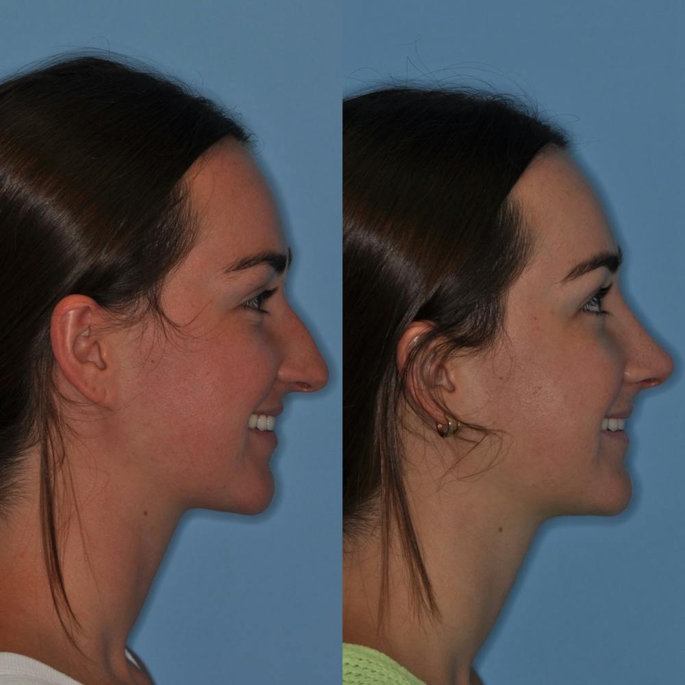 Rhinoplasty Before & After Gallery - Patient 31710068 - Image 3