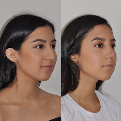 Rhinoplasty Before & After Gallery - Patient 31710069 - Image 1