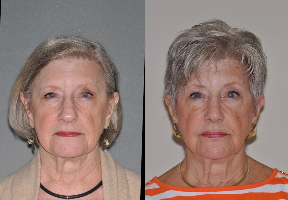 Rhinoplasty Before & After Gallery - Patient 31710071 - Image 1