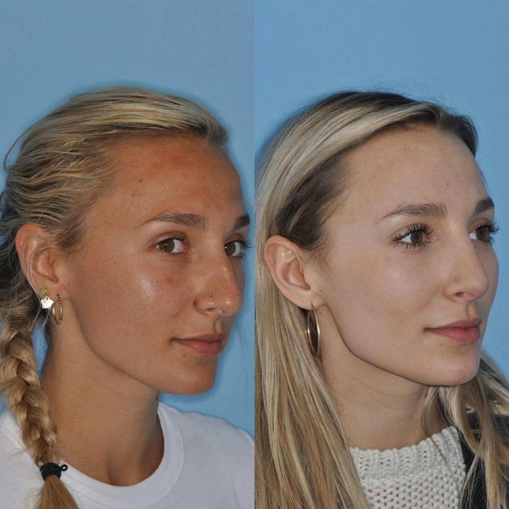 Rhinoplasty Before & After Gallery - Patient 31710065 - Image 5