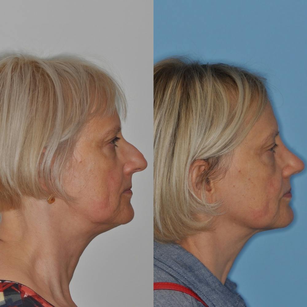 Rhinoplasty Before & After Gallery - Patient 31710066 - Image 5