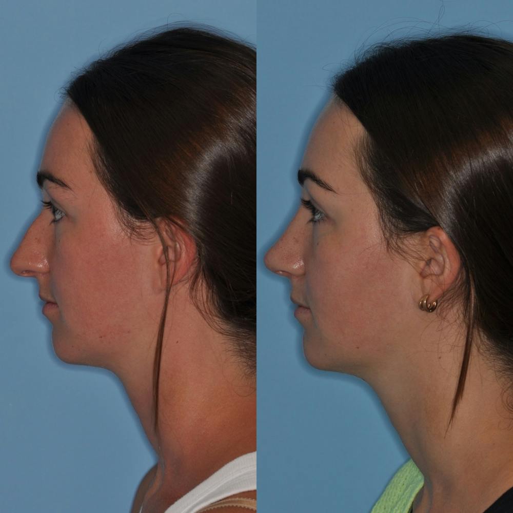 Rhinoplasty Before & After Gallery - Patient 31710068 - Image 4