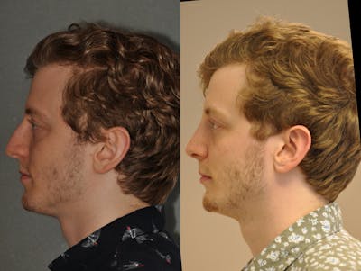 Rhinoplasty Before & After Gallery - Patient 31710067 - Image 4
