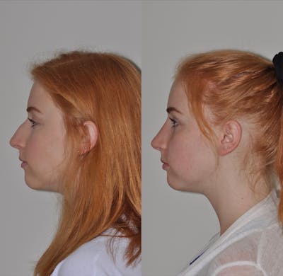 Rhinoplasty Before & After Gallery - Patient 31710072 - Image 1