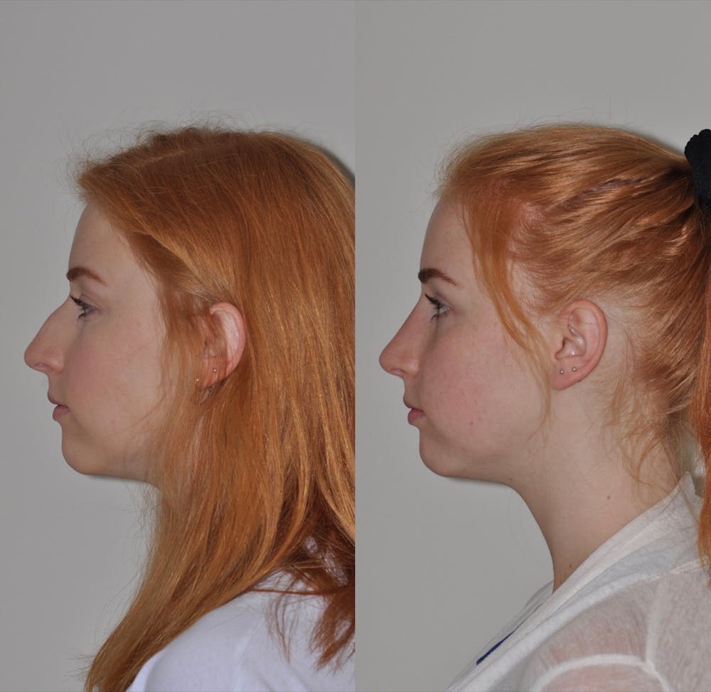 Rhinoplasty Before & After Gallery - Patient 31710072 - Image 1