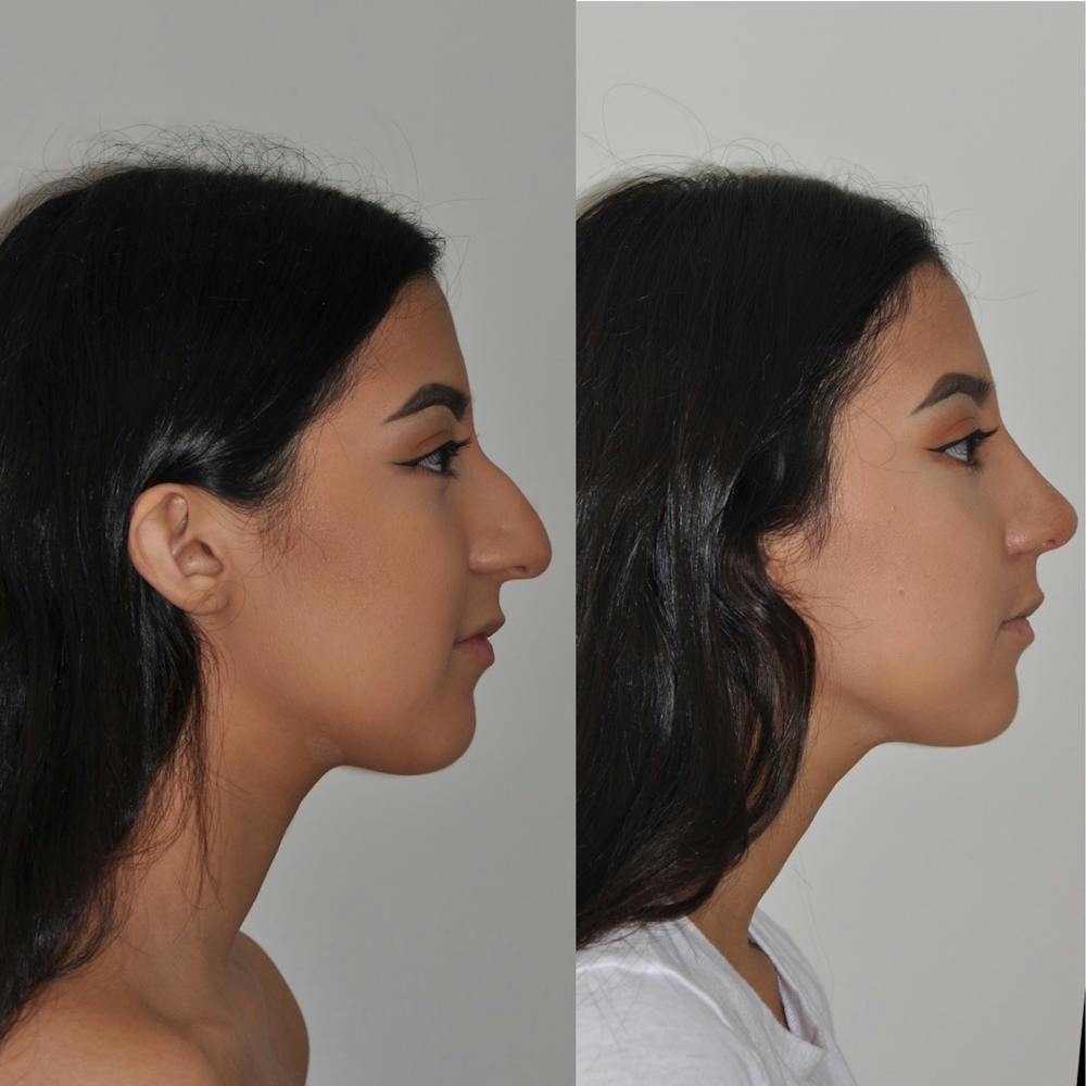 Rhinoplasty Before & After Gallery - Patient 31710069 - Image 2