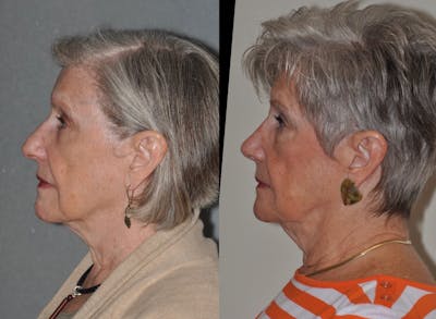 Rhinoplasty Before & After Gallery - Patient 31710071 - Image 2