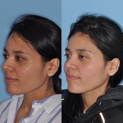 Rhinoplasty Before & After Gallery - Patient 31710073 - Image 1