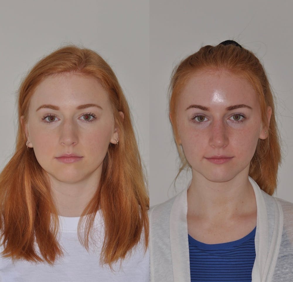 Rhinoplasty Before & After Gallery - Patient 31710072 - Image 2
