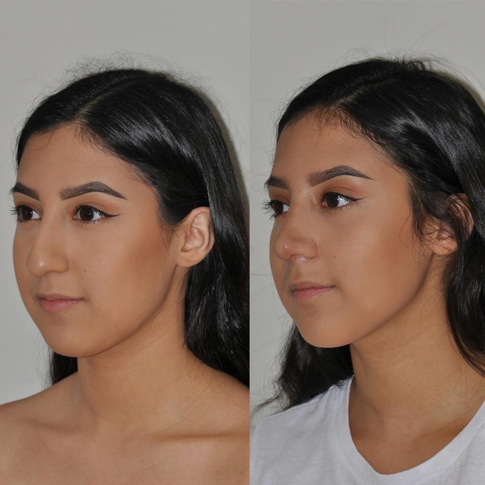 Rhinoplasty Before & After Gallery - Patient 31710069 - Image 3