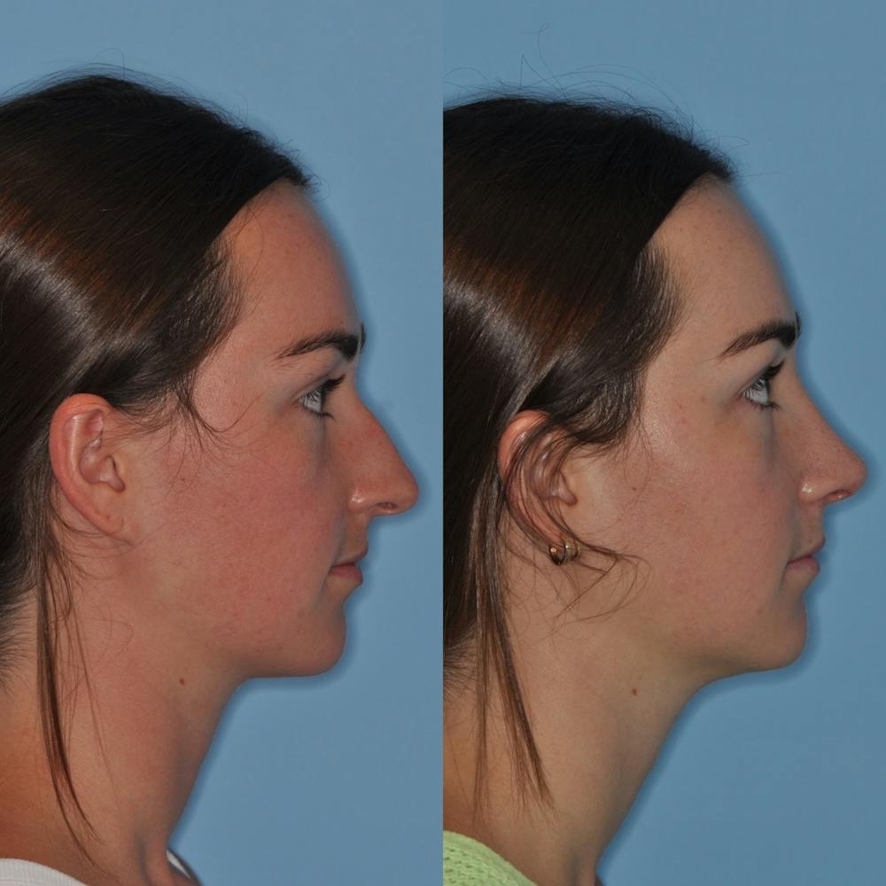 Rhinoplasty Before & After Gallery - Patient 31710068 - Image 6