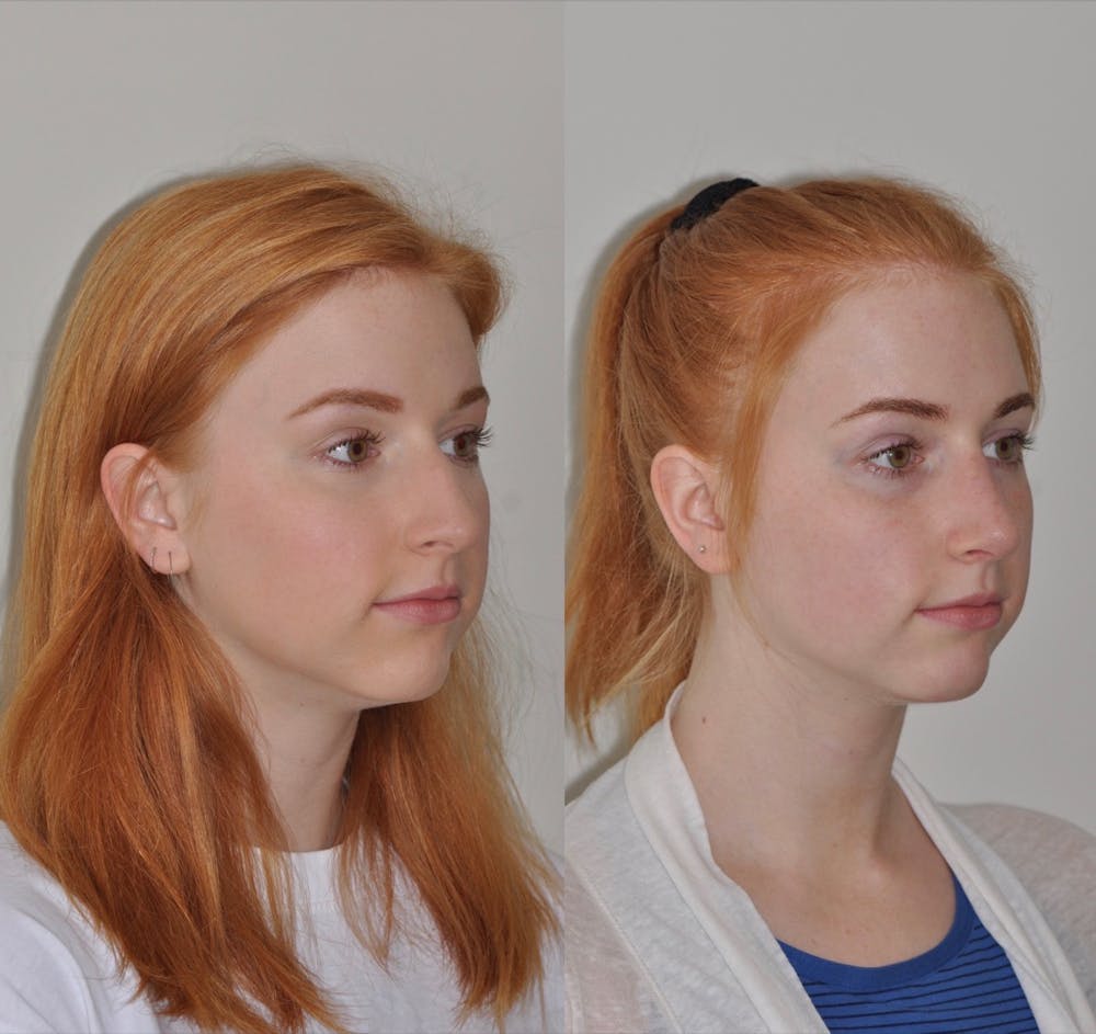 Rhinoplasty Before & After Gallery - Patient 31710072 - Image 3