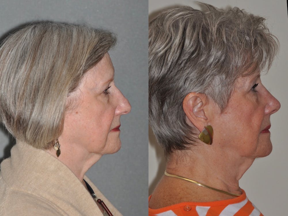 Rhinoplasty Before & After Gallery - Patient 31710071 - Image 3