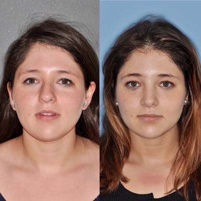 Rhinoplasty Before & After Gallery - Patient 31710074 - Image 1