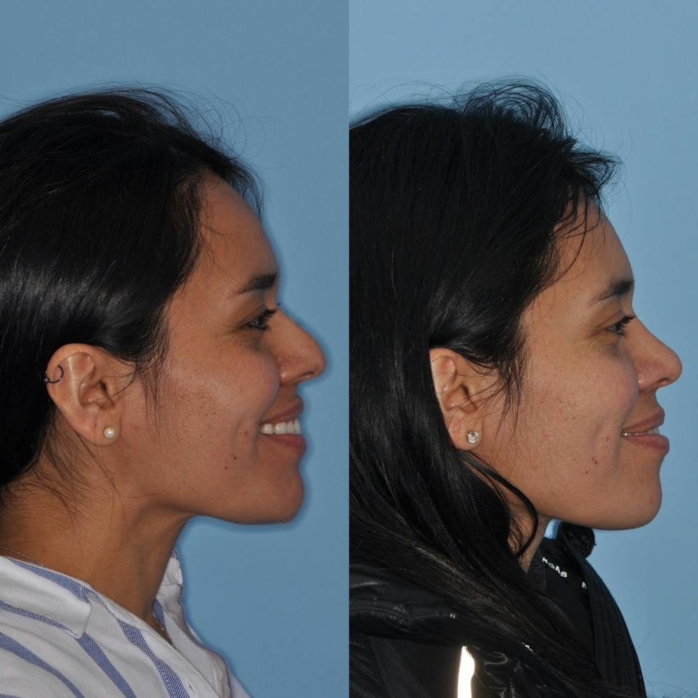 Rhinoplasty Before & After Gallery - Patient 31710073 - Image 3