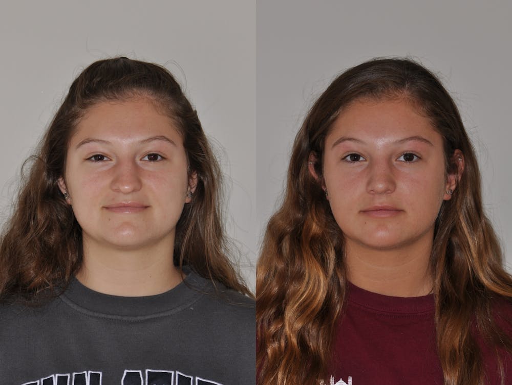 Rhinoplasty Before & After Gallery - Patient 31710070 - Image 5