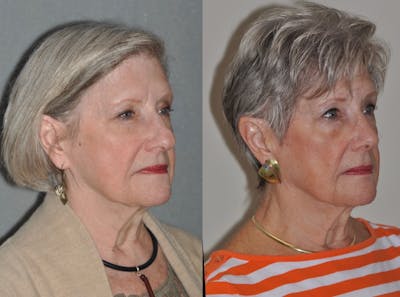 Rhinoplasty Before & After Gallery - Patient 31710071 - Image 4