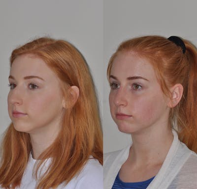 Rhinoplasty Before & After Gallery - Patient 31710072 - Image 4