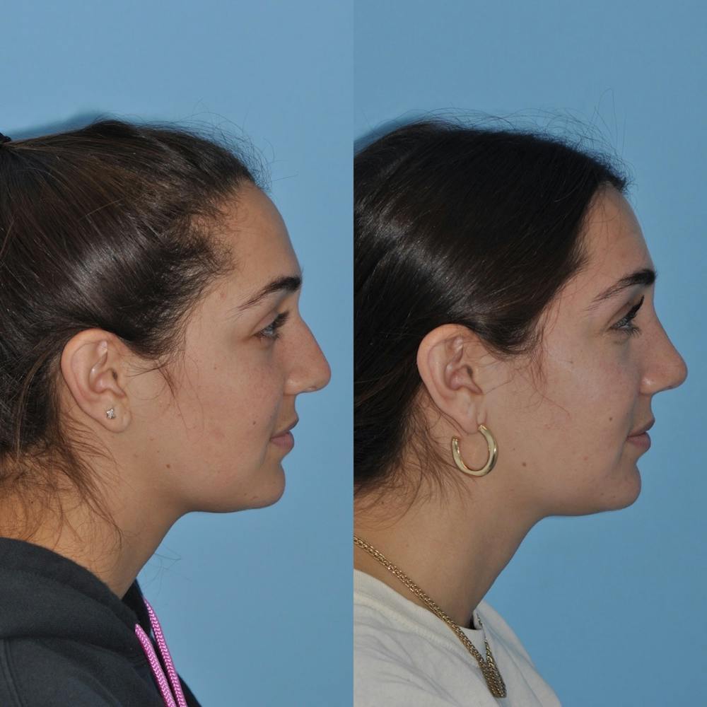 Rhinoplasty Before & After Gallery - Patient 31710075 - Image 1