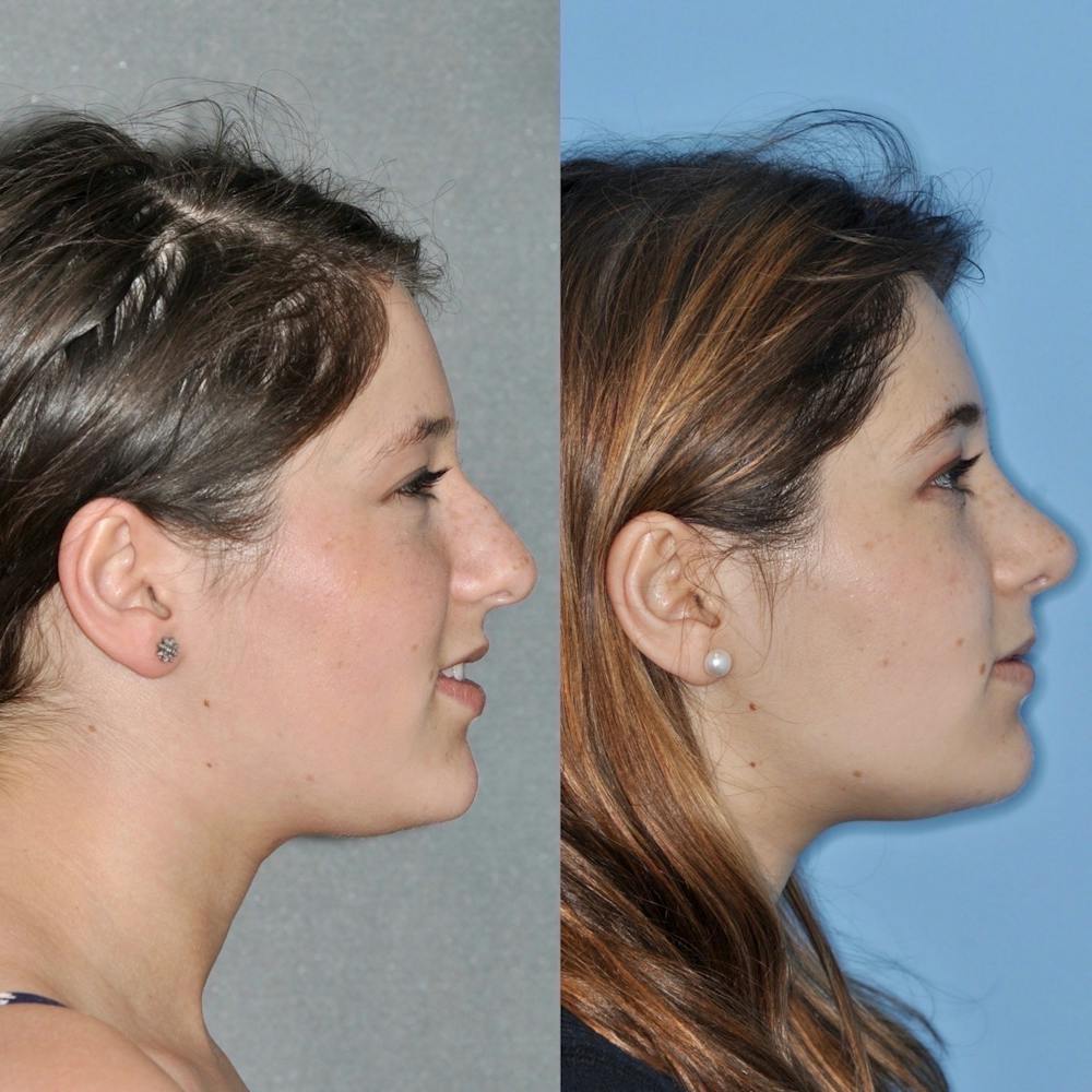 Rhinoplasty Before & After Gallery - Patient 31710074 - Image 2