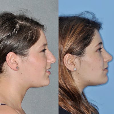 Rhinoplasty Before & After Gallery - Patient 31710074 - Image 2