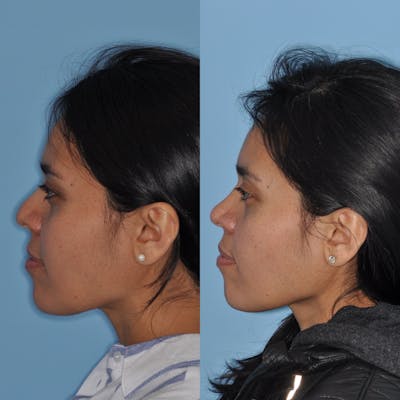 Rhinoplasty Before & After Gallery - Patient 31710073 - Image 4