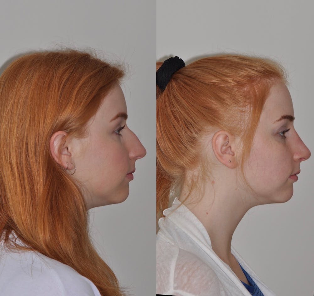 Rhinoplasty Before & After Gallery - Patient 31710072 - Image 5