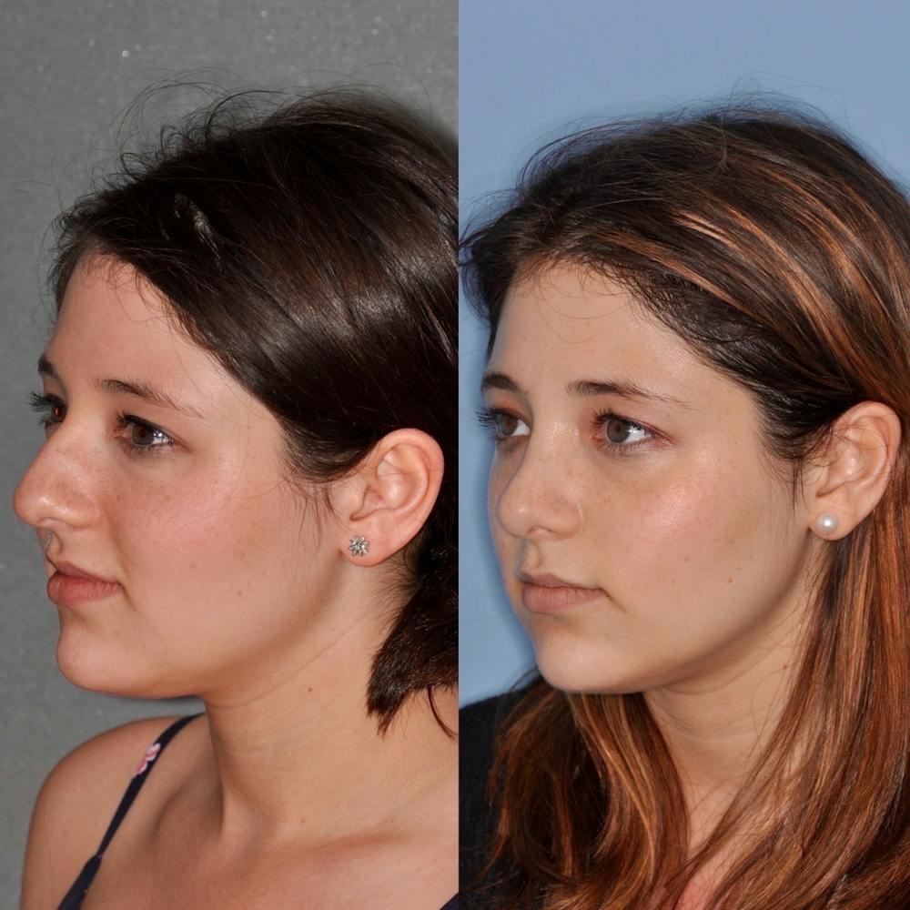 Rhinoplasty Before & After Gallery - Patient 31710074 - Image 3