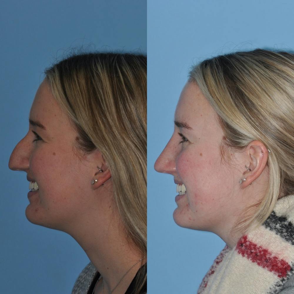 Rhinoplasty Before & After Gallery - Patient 31710076 - Image 1