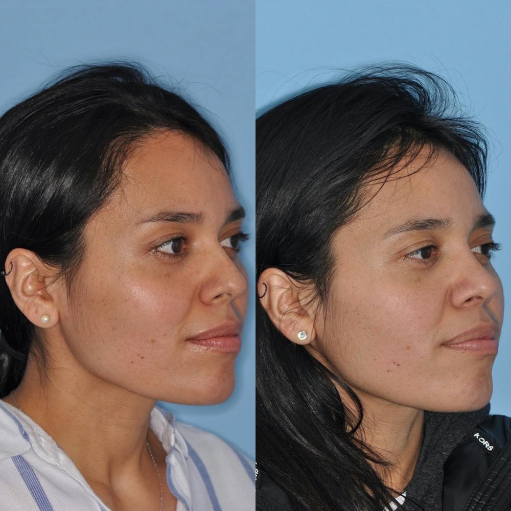 Rhinoplasty Before & After Gallery - Patient 31710073 - Image 5