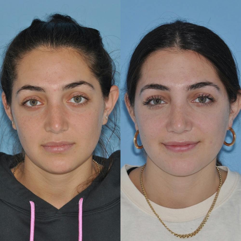 Rhinoplasty Before & After Gallery - Patient 31710075 - Image 3