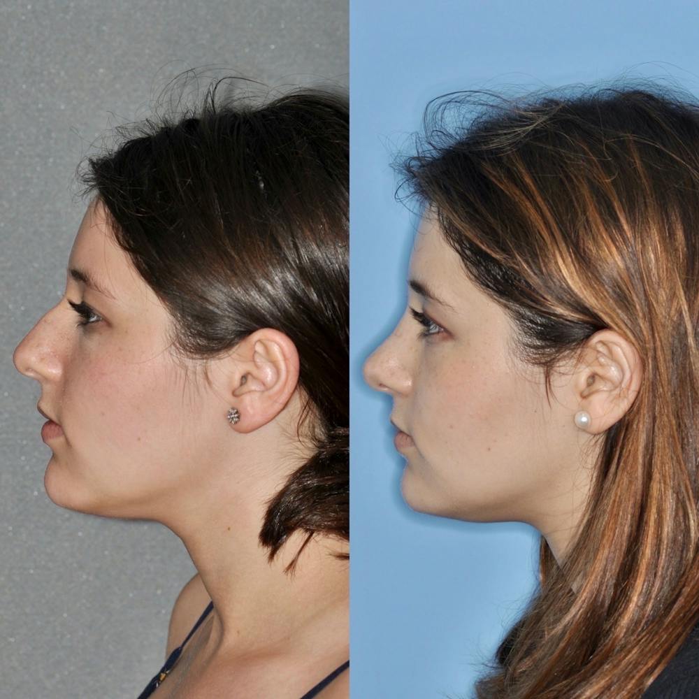 Rhinoplasty Before & After Gallery - Patient 31710074 - Image 4