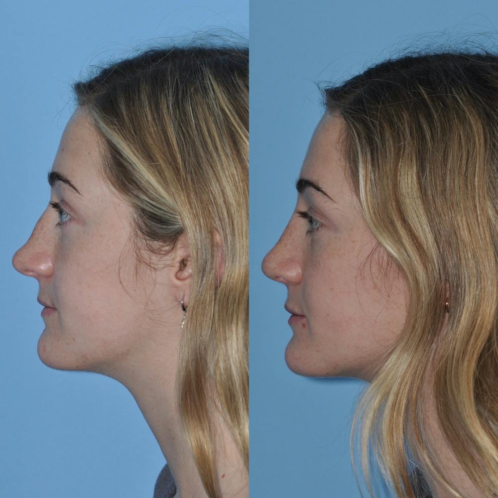 Rhinoplasty Before & After Gallery - Patient 31710077 - Image 1