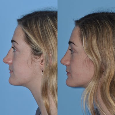 Rhinoplasty Before & After Gallery - Patient 31710077 - Image 1