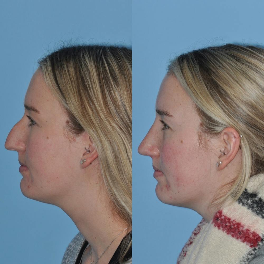 Rhinoplasty Before & After Gallery - Patient 31710076 - Image 2