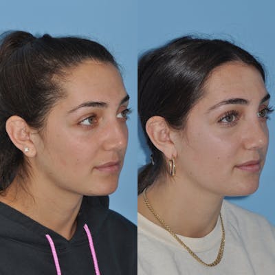 Rhinoplasty Before & After Gallery - Patient 31710075 - Image 4