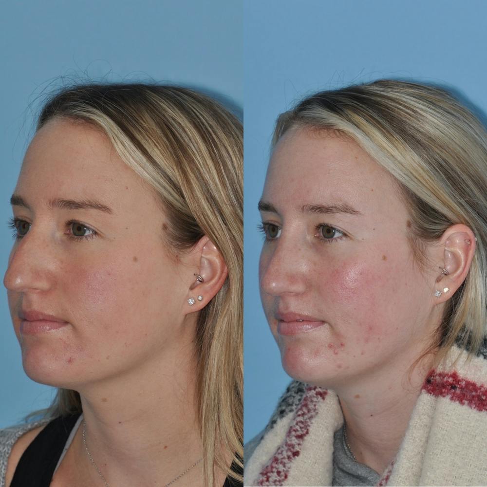 Rhinoplasty Before & After Gallery - Patient 31710076 - Image 3