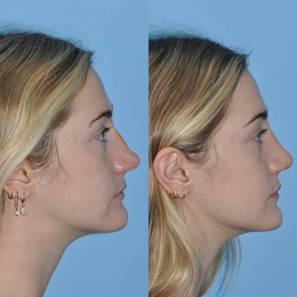 Rhinoplasty Before & After Gallery - Patient 31710077 - Image 2