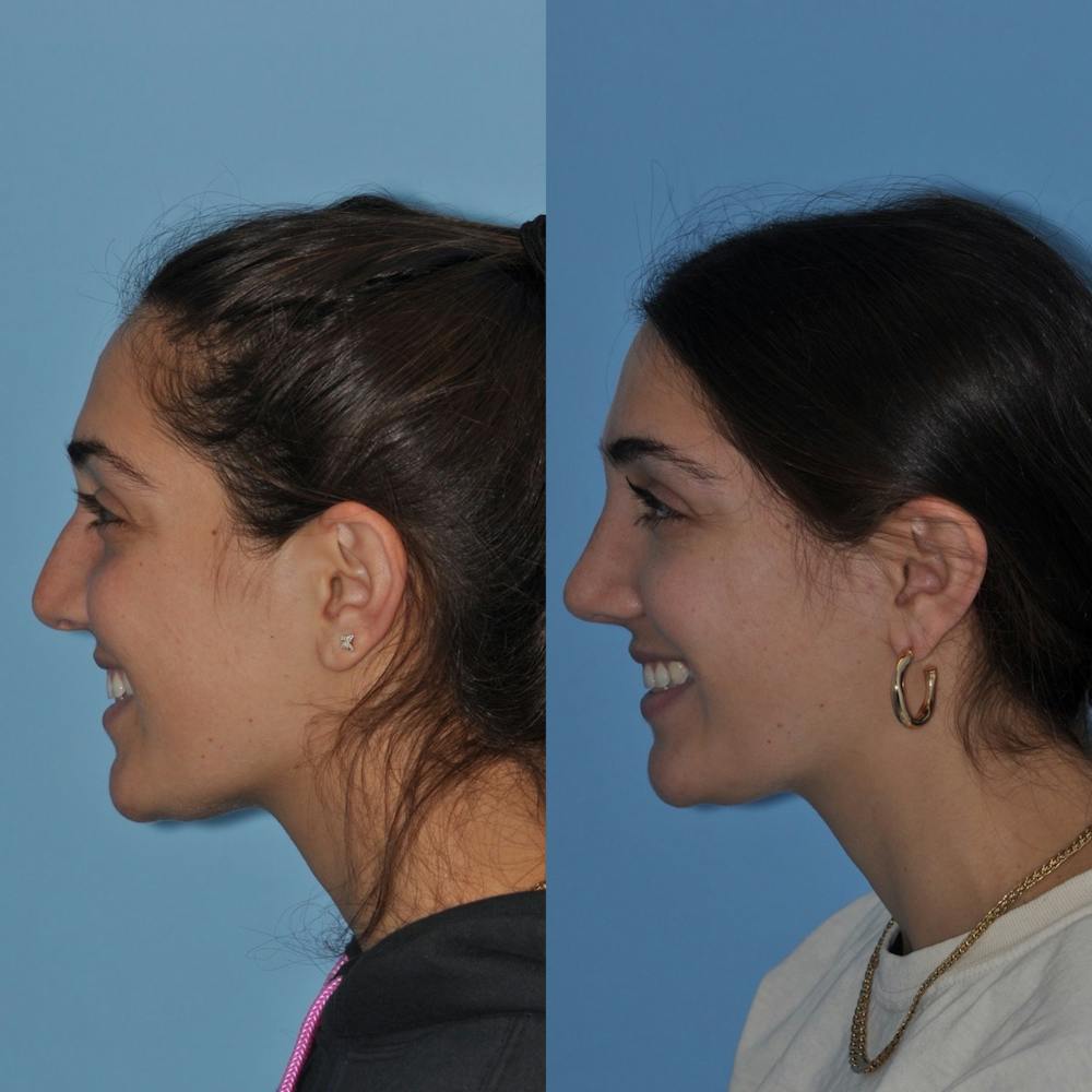 Rhinoplasty Before & After Gallery - Patient 31710075 - Image 5